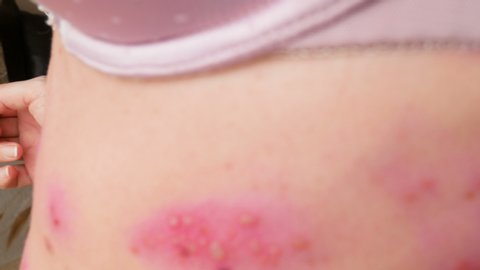 skin rash treatment on woman body. Shingles, Disease, Herpes zoster, varicella-z