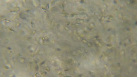 Moving Human Sperm Under Phase Contrast Microscope. Sperm (Spermatozoa) Viewed Under Microscope. Close Up Showing Spermatozoon. Video Human Semen. Macro Closeup. Medical Science Laboratory.