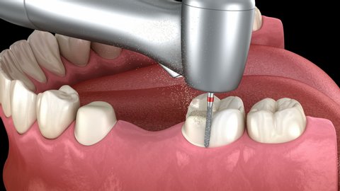Amalgam removing and preparation for ceramic bridge placement. Medically accurate 3D animation