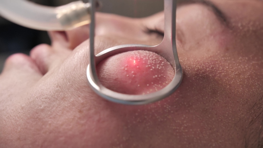 Extreme Close-Up Shot. A young woman having laser skin treatment/laser resurfacing/laser facial peeling with Co2 laser in a cosmetology/plastic surgery clinic. Royalty-Free Stock Footage #1045778233