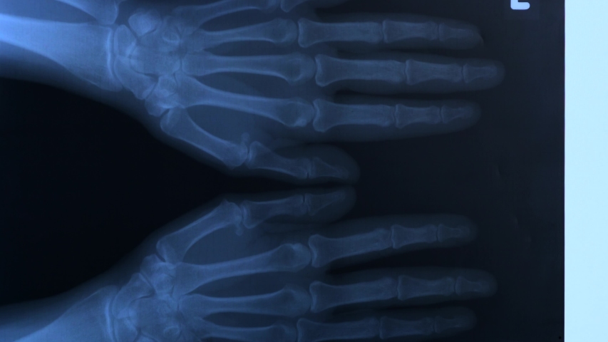 Doctor studying X-ray plate of the bones of the both human hands, 4K Royalty-Free Stock Footage #1046073790