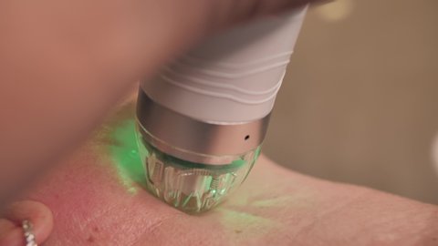 Super close-up of a woman's neck. Microneedling Radio frequency (RF) lifting procedure.