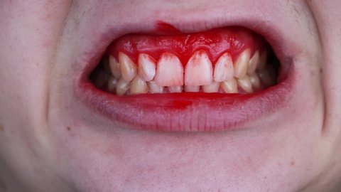 The Shocking Truth About Soft Palate Bruises Are You At Risk - 0qiyzbr