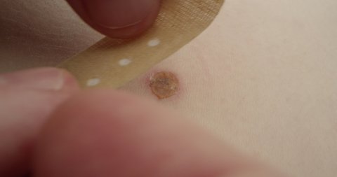 Putting Adhesive Bandage Plaster on a Skin Wound Injury a Macro Shot on Red Camera