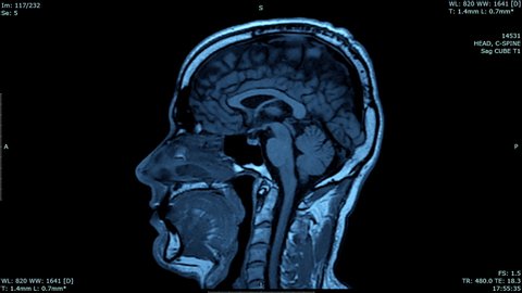 MRI scan. Magnetic resonance imaging. Human brain.