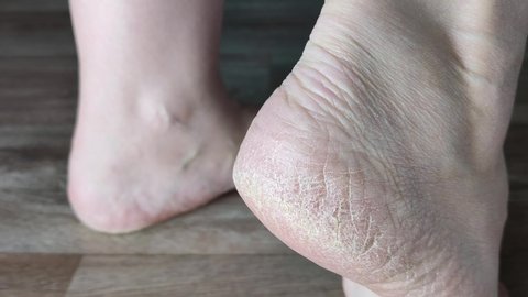 Cracked heels, white female feet. Close-up. Dry skin, health problems, need for pedicure