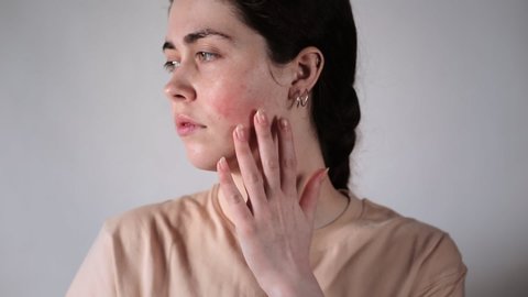 Portrait of a young Caucasian woman showing redness and inflamed blood vessels on her cheeks. Close up. Gray background. The concept of rosacea