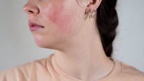Close up portrait of a young Caucasian woman showing redness and inflamed blood vessels on her cheeks. Gray background. The concept of rosacea