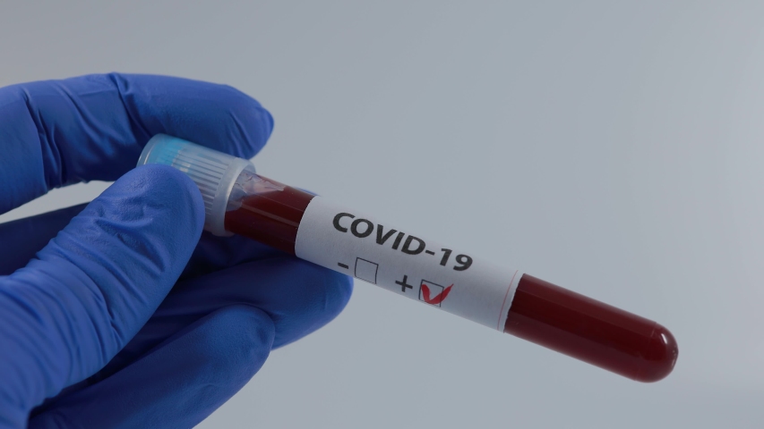 Closeup of microbiologist or medical worker hand with blue surgical gloves marking blood test result as positive for the new rapidly spreading Coronavirus. COVID-19 Positive concept
