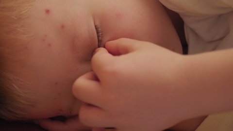 A little sad boy with chickenpox is lying on a bed at home. The child has a lot of blisters and smallpox from chickenpox on the skin.