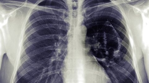 Normal Chest Xray High Resolution Pa Stock Photo 1305132859 | Shutterstock