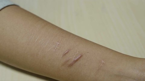Scars on the wrist and arm of a person who tried to commit suicide then holds a razor, knife or scapel to her wrist