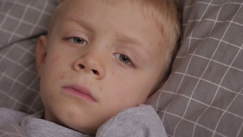 A close-up portrait of a small sick boy in bed, with red rashes on his skin from chickenpox. A sick child with a high fever is lying in bed.