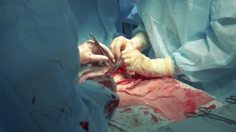Surgeons are stitching patient's stomach