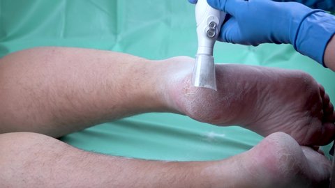 Callus peeling using professional pedicure tool.  Removing hard, callused skin on the feet
