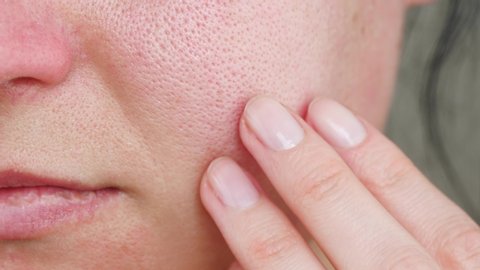 Macro skin with enlarged pores. The girl touches the irritated red skin with her fingers. Allergic reaction, peeling, care for problem skin. Beauty and cosmetology.