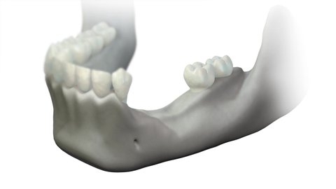 Animation of bone subsidence on the lower jaw, in the place where the teeth are lost. Bone Loss with no gums. Surgery using bone graft and Bone regeneration is needed. 3D dental.