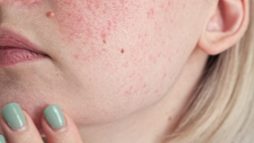 Close up of skin problems, unhealthy skin with acne and pimples. Porous, demodex and rosacea, red rashes. The concept of care for problem skin. Allergic and redness. | Shutterstock HD Video #1048432993