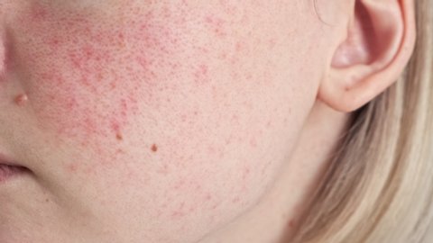 Close up of skin problems, unhealthy skin with acne and pimples. Porous, demodex and rosacea, red rashes. The concept of care for problem skin. Allergic and redness.