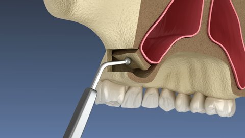 Sinus Lift Surgery with lateral access. 3D animation of dental surgery