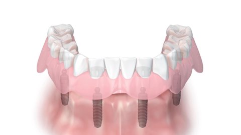 Schematic animation showing what parts ball attachment superstructure  is made of. Lower Jaw Complete Denture putting on Ball abutment and silicone. All on 4 dental implants. Gum tissue is transparent