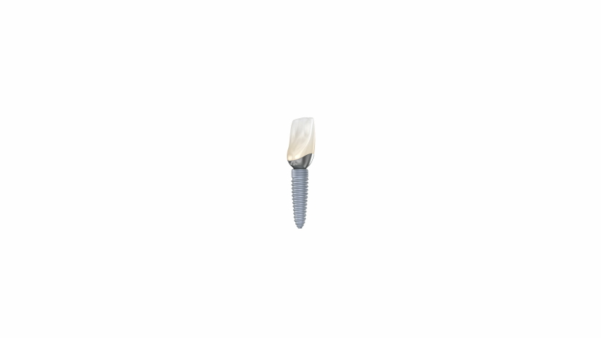 Ceramic crown, custom implant abutment and implantat instalation process. Medically accurate 3D animation of dental implantation Royalty-Free Stock Footage #1048924432