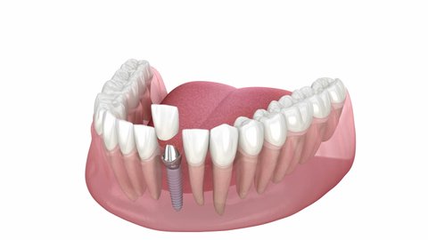 Ceramic crown, custom implant abutment and implantat instalation process. Medically accurate 3D animation of dental implantation