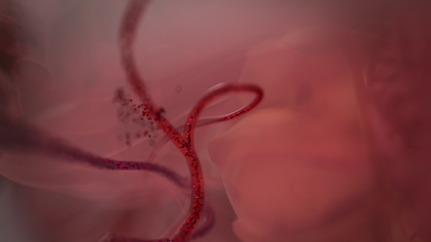 Hemorrhagic stroke. 3D animation of hemorrhage and brain damage