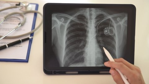 Doctor using digital tablet check up image of pacemaker cell implantation cardioverter defibrillator in chest's patient.