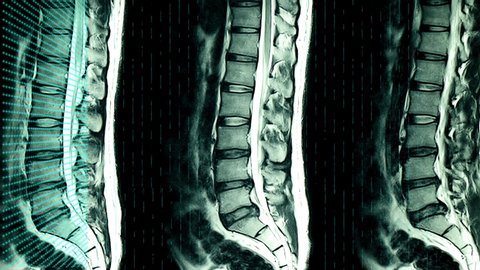 An MRI scan of lumbar and sacrum of a patient with herniated disc with grid of blue green lights animation of the scanning process. Animated or animation MRI film.