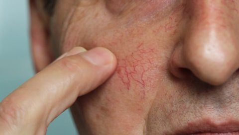 Man's face skin with vascular stars and couperose. Close up view of capillaries on the skin, telangiectasias
