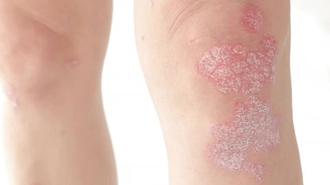 A woman using anti-inflammatory drugs for corticosteroids for psoriasis. The use of therapeutic ointments to soothe pluritis on the knees. Treatment of skin diseases - psoriasis, eczema, dermatitis