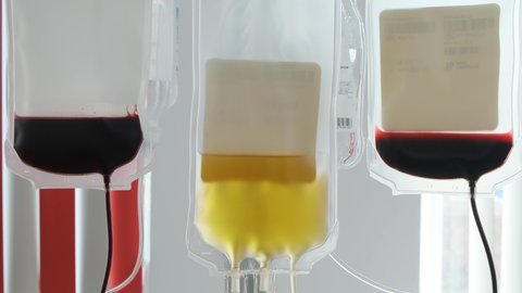 Plasmapheresis. Showing plastic bags with blood and components. Removal, treatment, return or exchange of blood plasma or components in the blood circulation 4k