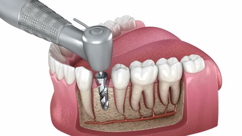 Missing teeth recovery with Implant: 3D animation of Drilling, implantat instalation, abutment and crown fixation