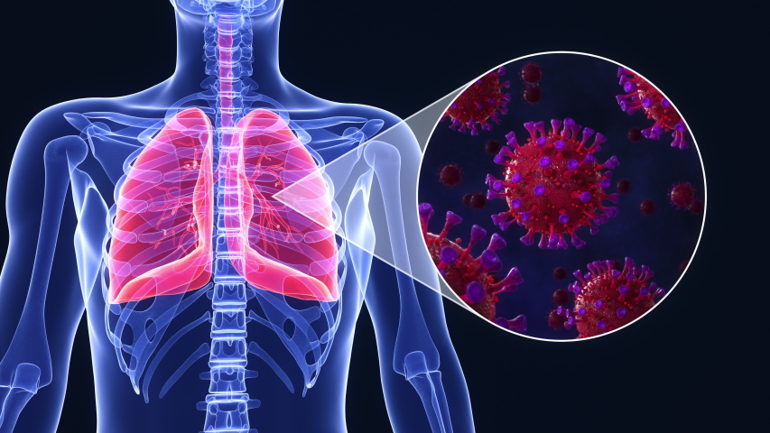 medical animation sars-cov-2 coronavirus infected lungs Stock Footage ...