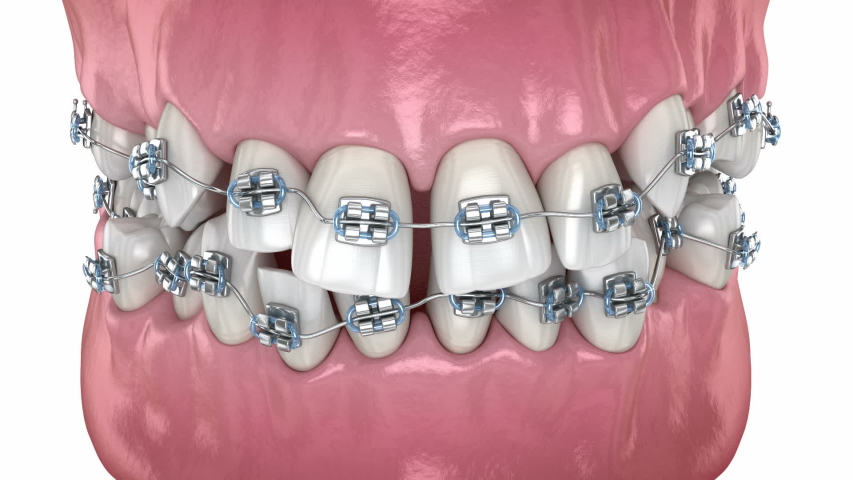 Abnormal teeth position and correction with metal braces treatment. Medically accurate dental 3D animation | Shutterstock HD Video #1050044767