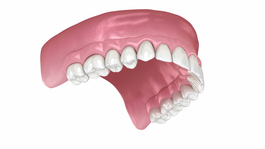 Maxillary prosthesis All on 4 system supported by implants. Medically accurate 3D animation of human teeth and dentures concept Royalty-Free Stock Footage #1050044776