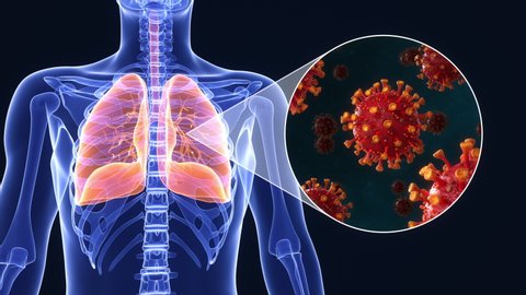 Medical animation of SARS-CoV-2 coronavirus infected lungs causing diffuculty in breathing or pneumonia or othercovid-19 related lung disease. Realistic high quality 3d medical animation.