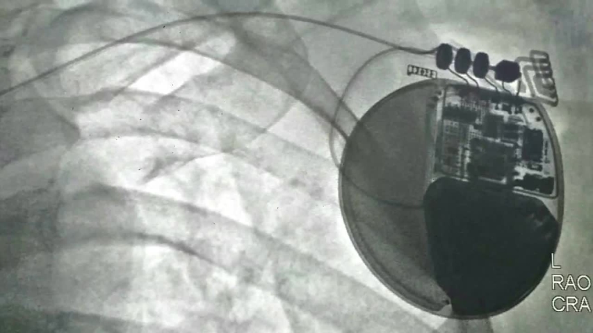 Fluoroscopy after defibrillator implantation.the leads for intracardiac defibrillator devices are guided under fluoroscopic observation to aid in the location and fixation of lead in heart chamber. Royalty-Free Stock Footage #1050120193