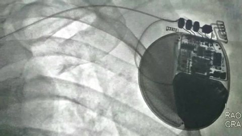 Fluoroscopy after defibrillator implantation.the leads for intracardiac defibrillator devices are guided under fluoroscopic observation to aid in the location and fixation of lead in heart chamber.