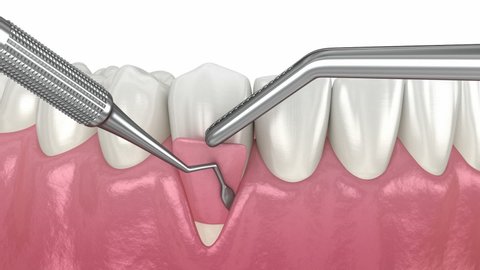Gum Recession: Soft tissue graft surgery. 3D animation of Dental procedure 