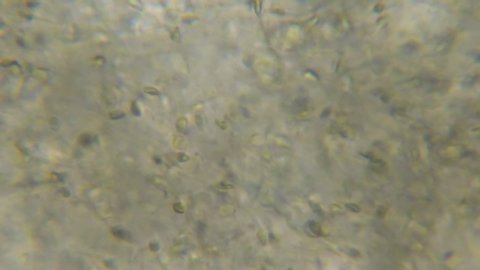 Moving Human Sperm Under Phase Contrast Microscope. Sperm (Spermatozoa) Viewed Under Microscope. Close Up Showing Spermatozoon. Video Human Semen. Macro Closeup. Medical Science Laboratory.