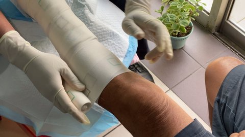 Melaka/Malaysia - April 9,2020 : A wound care nurse doing compression bandaging to a patient with venous leg ulcer to help reducing the leg oedema and improve wound healing