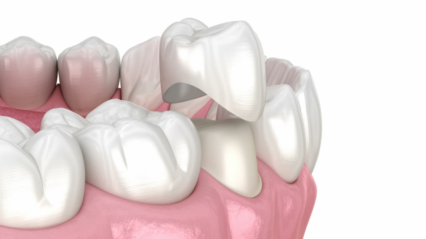 Preparated premolar tooth for dental ceramic crown placement. Medically accurate  3D animation Royalty-Free Stock Footage #1050486805