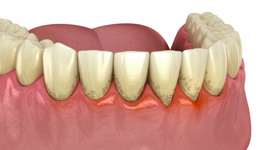 Periodontitis testing, gum recession process. Medically accurate 3D animation | Shutterstock HD Video #1050486808