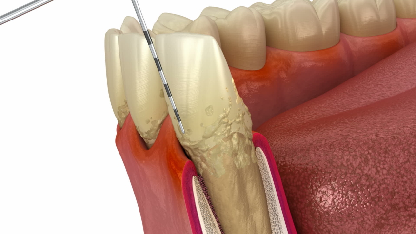 Periodontitis testing, gum recession process. Medically accurate 3D animation | Shutterstock HD Video #1050486808