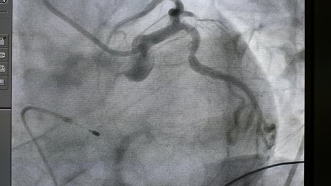 coronary angiogram (CAG) was showed normal left coronary artery (LCA) and temporary pacemaker insertion