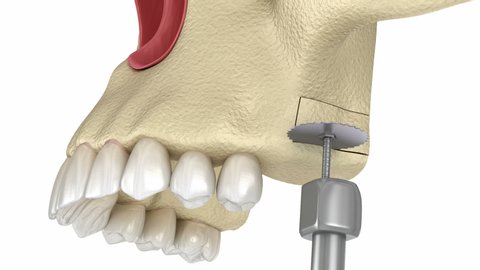 58 Maxillary Sinus Stock Video Footage - 4K and HD Video Clips | Shutterstock 58 Maxillary Sinus Stock Video Footage - 4K and HD Video Clips | Shutterstock