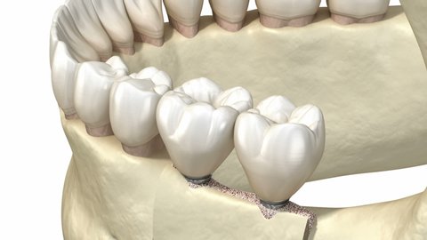 Cleavage of the alveolar ridge, augmentation, implantation. Dental surgery, 3D animation.
