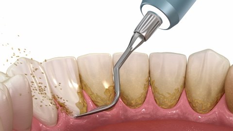 Oral hygiene: Teeth Cleaning Ultrasonic Scaling (conventional periodontal therapy). Medically accurate 3D animation of human teeth treatment